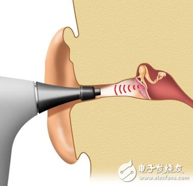 MEMS超声换能器助力中耳感染快速诊断